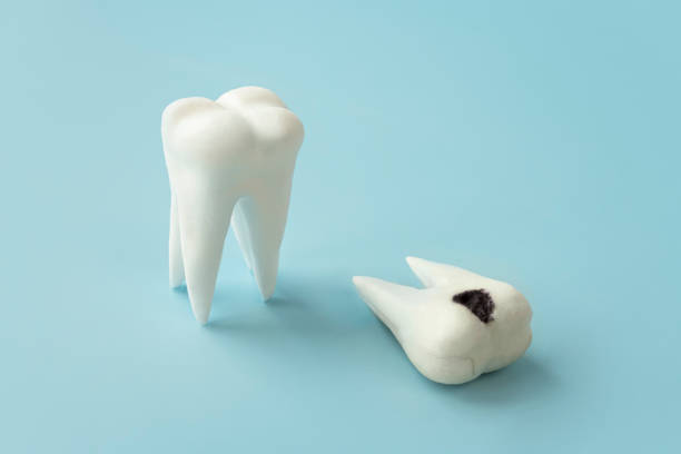 image of a healthy tooth model and one with cavities